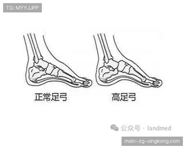 足部重塑：篮球鞋造成的畸形与手术，篮球鞋足弓凸起